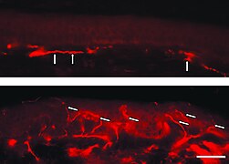 Fluorescentne slike smrznutog dela kože pacijenta sa Fabrijevom bolešću. Nedostatak intraepidermalnih nervnih vlakana i prisustvo vlakana koja pripadaju subepidermalnom nervnom pleksusu (strelice) su upadljivi. Donji uzorak kože, s druge strane, dolazi sa leđa pacijenta. Ovde je upadljiva gusta inervacija epidermisa (strelice).