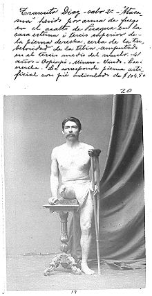 Photo of Chilean private first class Transito Diaz, injured during the landing on Pisagua. The photo belongs to the "Album de invalidos de la Guerra del Pacifico", 130 photographic records ordered by the D. Santa Maria government to demonstrate the pensions and orthopedic devices given to disabled war veterans. Ten percent of the expeditionary force, 4,081 Chilean soldiers, returned disabled from the war. In 2008, 280 women were receiving a pension as the daughter or wife of a veteran. Mutilado-en-la-GdP-21.jpg