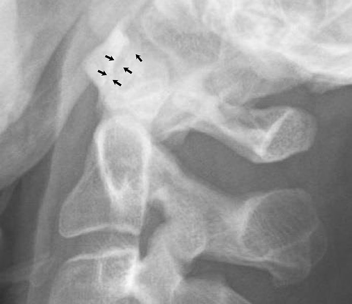 File:Normal atlanto-dental joint on X-ray.jpg