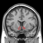 Miniatura per Nucleus accumbens