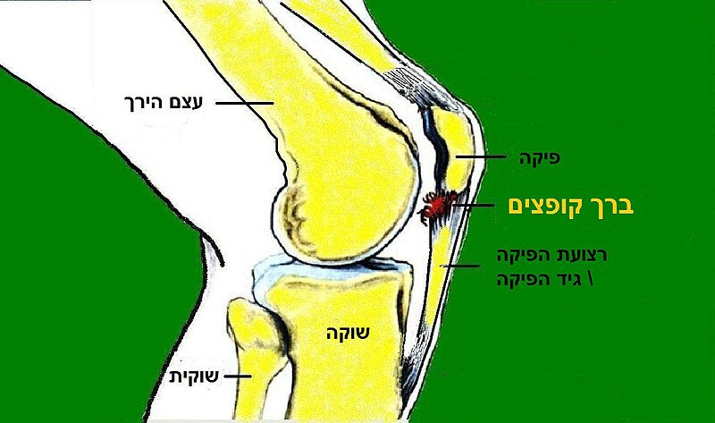 File:Patellar tendinopathy.jpg