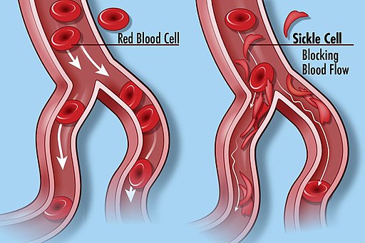 Sickle Cell Disease (27249799083)