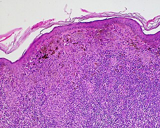 <span class="mw-page-title-main">Halo nevus</span> Medical condition