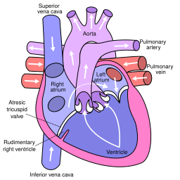 Tricuspid atresia.svg