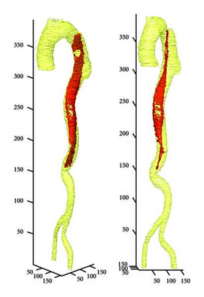 File:3D-visualization-of-aortic-dissection.jpg