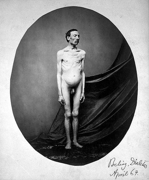 File:A naked man, standing; despite his emaciation, his abdomen i Wellcome L0017632.jpg