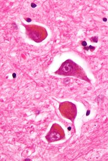 Micrograph of Alzheimer type II astrocytes, as may be seen in hepatic encephalopathy Alzheimer type II astrocyte high mag cropped.jpg