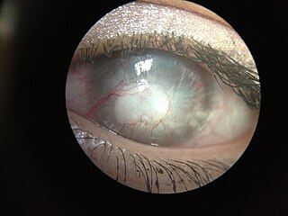 <span class="mw-page-title-main">Corneal neovascularization</span> Medical condition