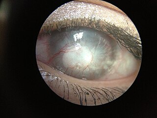 Corneal opacity symptom