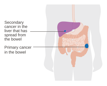 File:Diagram showing a primary and secondary cancer CRUK 074.svg