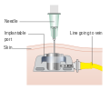 Diagram showing an implantable port under the skin CRUK 100.svg