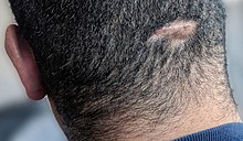 Boggy, suppurative nodule with patchy hair loss typical of dissecting cellulitis of the scalp