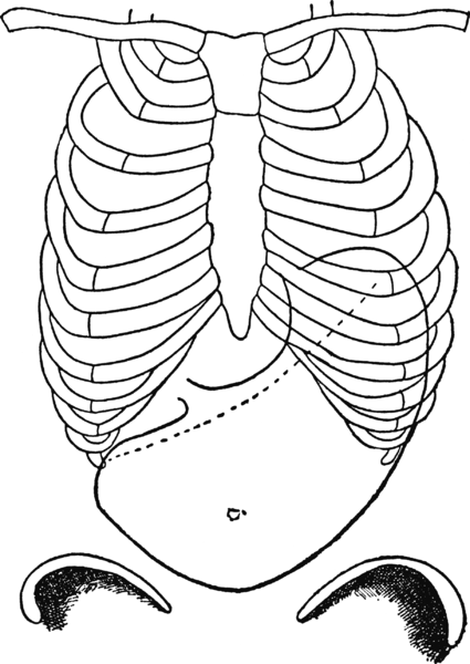 File:Estomac dilate insuffle ne presentant pas de dislocation d'apresRosenheim.gif