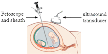 Drawing of an endoscope for fetal detection, or "fetoscope" Fetal-endoscope.gif