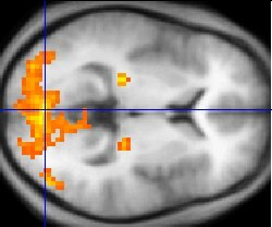 Since the 1980s, sophisticated neuroimaging procedures, such as fMRI (above), have furnished increasing knowledge about the workings of the human brai