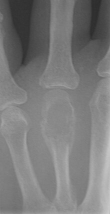 X-ray of a giant-cell bone tumor in the head of the fourth metacarpal of the left hand Giant cell tumor of bone08.JPG