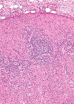 Histiocytic necrotizing lymphadenitis - intermed mag.jpg