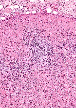 Histiocytic necrotizing lymphadenitis - intermed mag.jpg