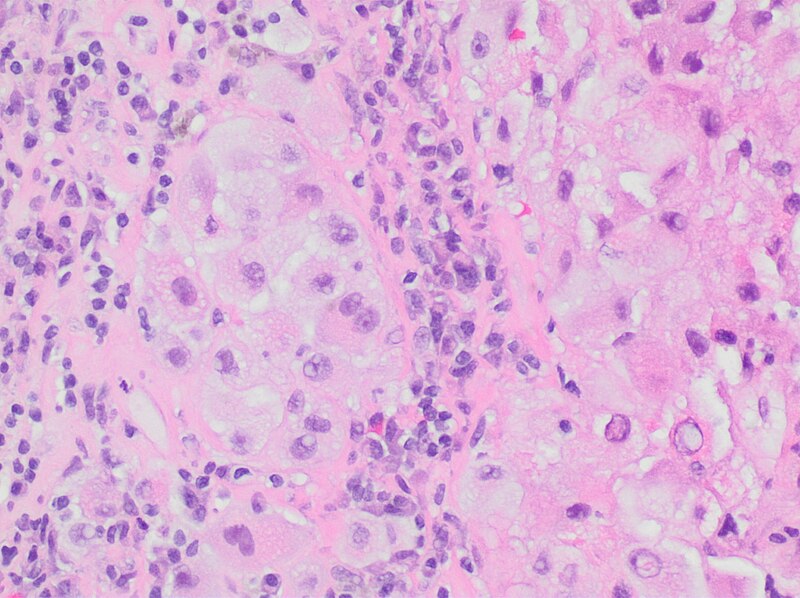 File:Histopathology of a metastatic melanoma to a lymph node.jpg