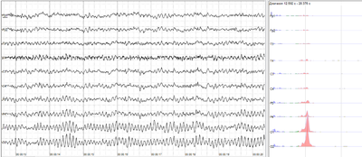Human EEG with prominent resting state activity – alpha-rhythm. Left: EEG traces (horizontal – time in seconds; vertical – amplitudes, scale 100 μV). Right: power spectra of shown signals (vertical lines – 10 and 20 Hz, scale is linear). Alpha-rhythm consists of sinusoidal-like waves with frequencies in 8–12 Hz range (11 Hz in this case) more prominent in posterior sites. Alpha range is red at power spectrum graph.