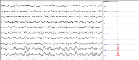 Electroencephalography