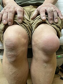 Left sided aseptic prepatellar bursitis in a retired concrete finisher. Left knee prepatellar bursitis.jpg