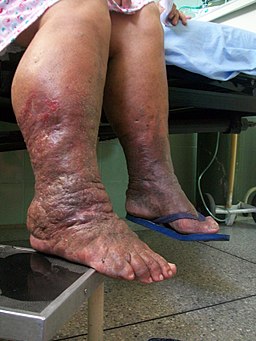 Lymphedema