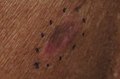 Malignant Melanoma Left Mid Back.jpg