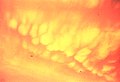 Mammatus globular, amb radar en 1r pla