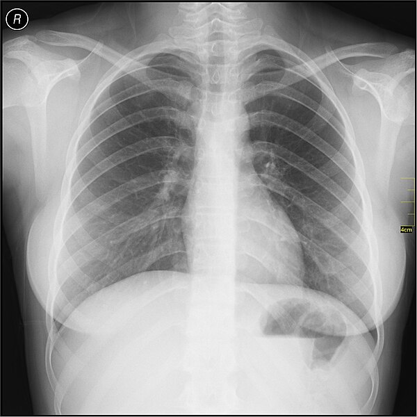 File:Medical X-Ray imaging OQY06 nevit.jpg