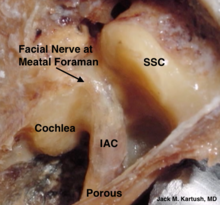 Middle cranial fossa surgical anatomy as demonstrated in a right cadaver temporal bone by Dr Jack M Kartush - view from above. Middle cranial fossa surgical anatomy - J M Kartush.png