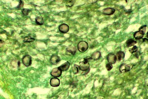 Pneumocystis carinii 01.jpg