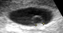 Contents in the cavity of the uterus seen at approximately 5 weeks of gestational age by obstetric ultrasonography. Ultrasound of embryo at 5 weeks.png