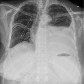 Serothorax