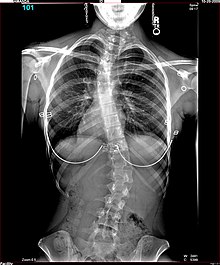 Amanda-Scoliosis.JPG