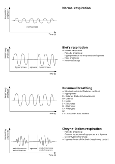 Cheyne–Stokes respiration Abnormal breathing pattern