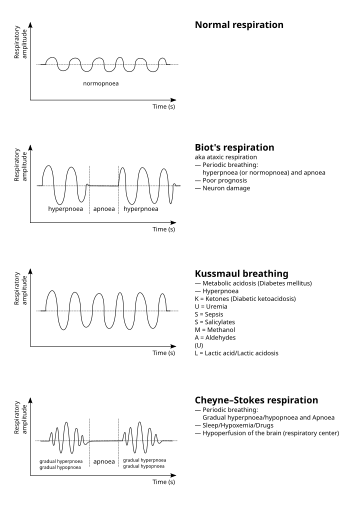 Kussmaul breathing