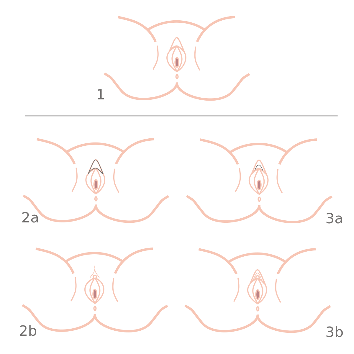 File:Clitoral Hood Reduction - Methods.svg - Wikimedia Commons 
