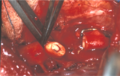 Coarctatio aortae - after excision a narrowing