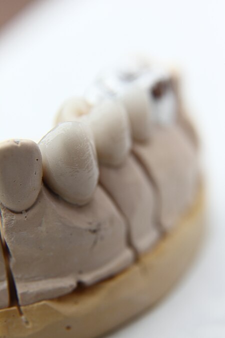 Fail:Dental bridge Focus stacking 1.JPG