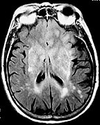 March 15: the brain tumor Gliomatosis cerebri