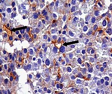 Immunohistochemistry using antibodies against CEA in a hepatocellular carcinoma, showing the typical canalicular pattern. Immunohistochemistry for CEA in hepatocellular carcinoma.jpg