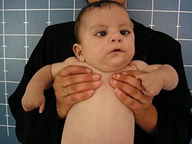طفل مصاب بمتلازمة موبيوس