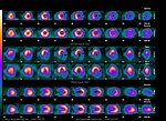 Vignette pour Scintigraphie myocardique