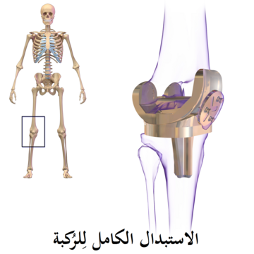 استبدال الركبة