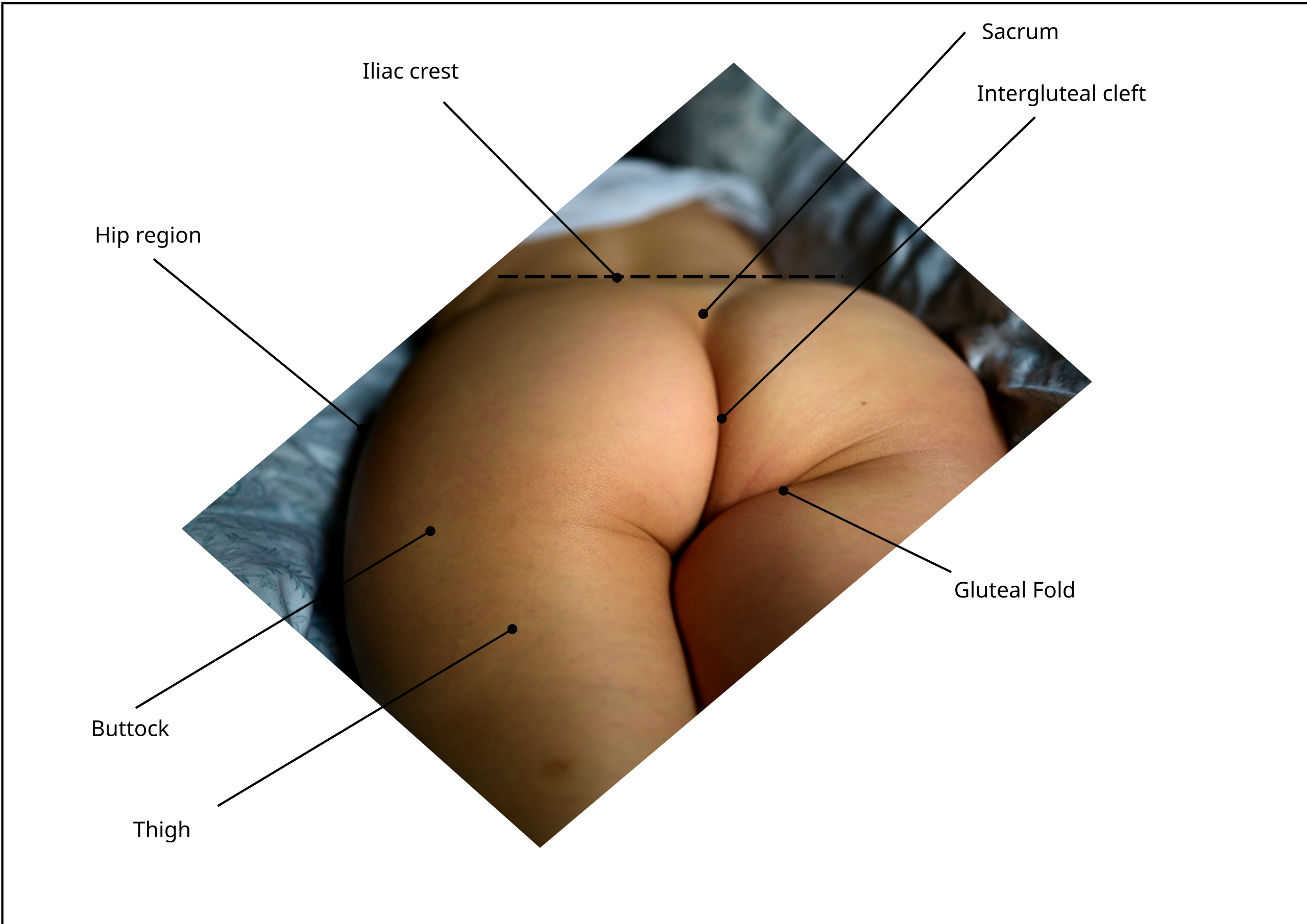 diagram of the gluteal fold