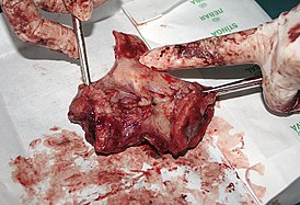 Larynx cancer 01.jpg