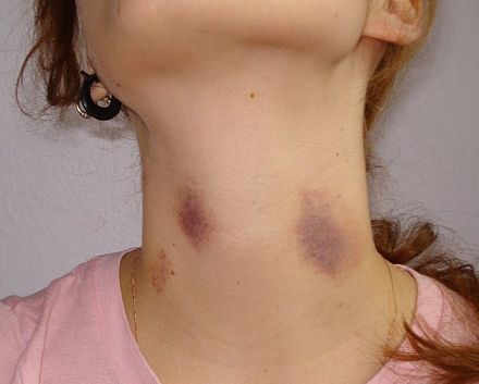 吻痕 – hickeys on the neck   4   九龙塘