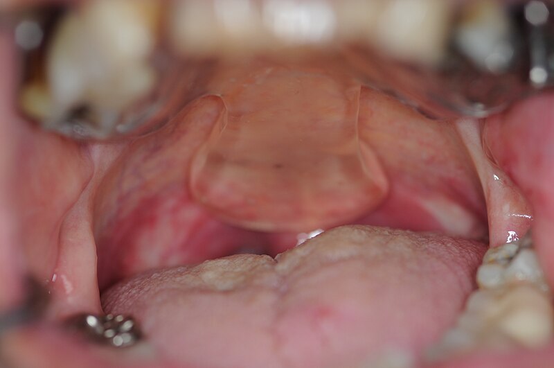 File:Palatal Lift Prosthesis Pharyngeal Extension.JPG