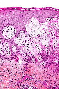 Pemphigoid gestationis - high mag.jpg